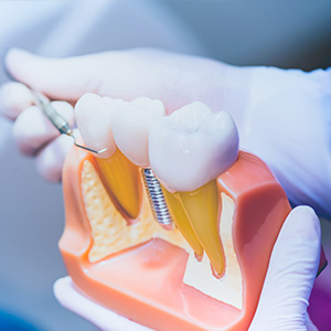 SKY Periodontics and Implant Dentistry | Pocket Reduction, Scaling and Root Planing and Dental Implants